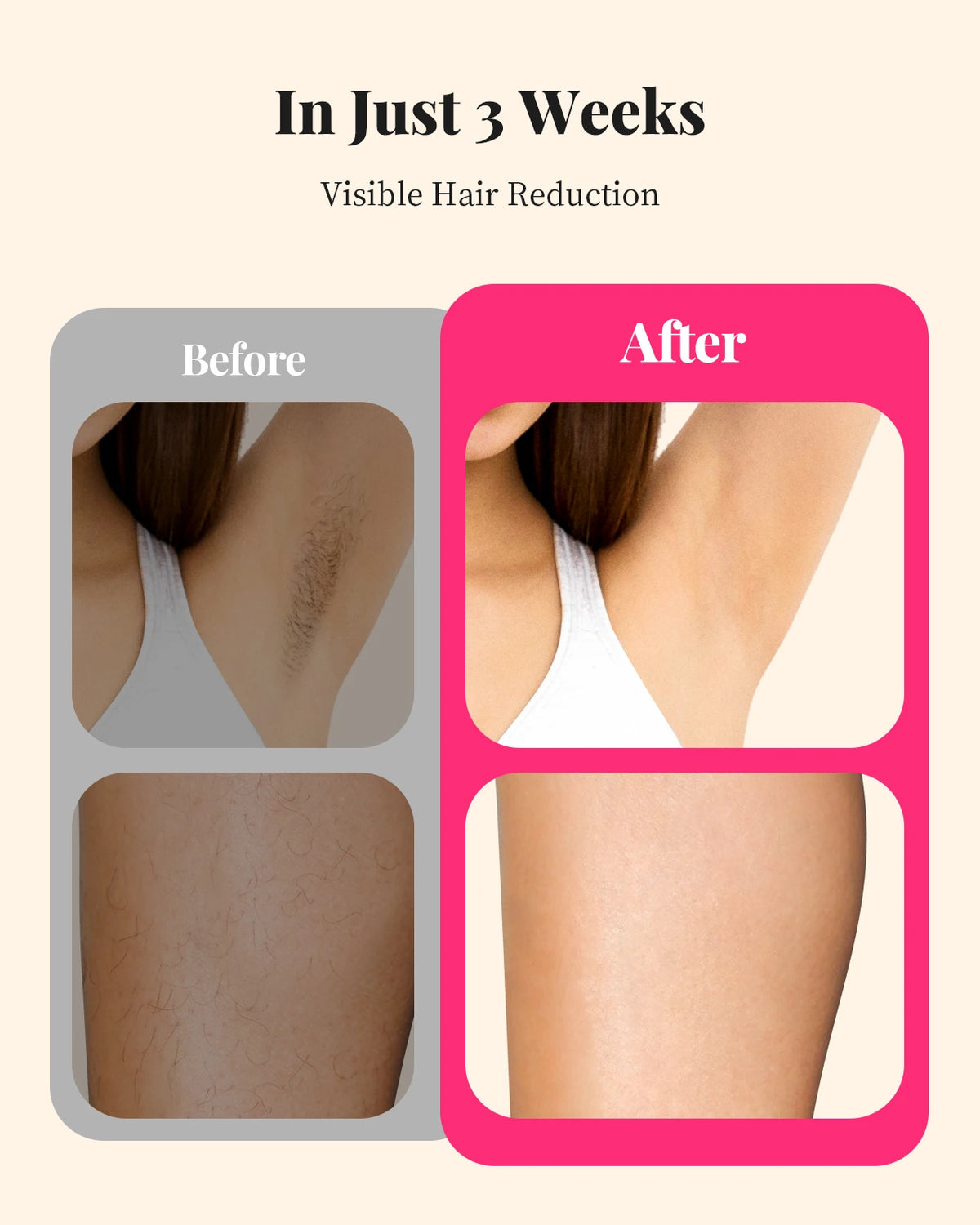990,000-Flash IPL Hair Removal, 5.2 cm² Window